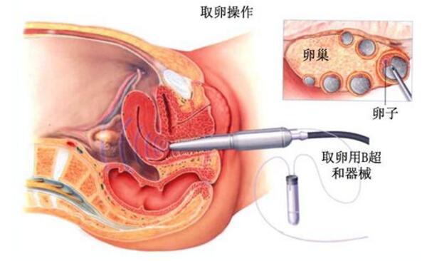 世南宁例借卵试管婴儿三胞胎今天满18岁(图)