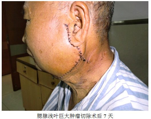供卵代生试管自卵取卵后多长时间可以进行移植？